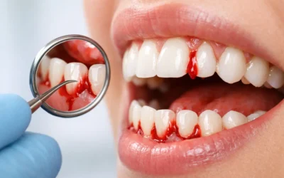 Why Do Gums Bleed? Common Causes