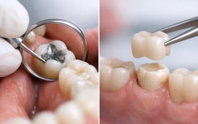 Tooth Filling or Crown: Which Do You Need?
