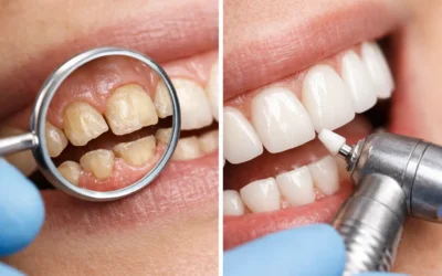 Restoring Worn Down Teeth with Lasting Care