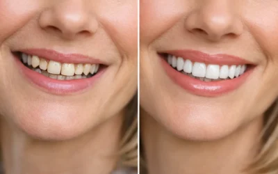 Smile Makeover Before After Example: What Changes?